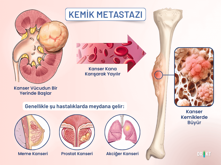 Başka bir bölgeden yayılan kanser hücrelerinin neden olduğu kemik metastazı, kemik yapısını bozarak dinlenmeyle geçmeyen bir kalça kemiği ağrısı yaratır.