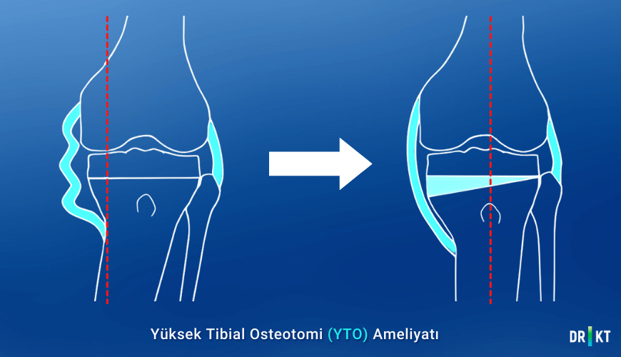 Yüksek tibial osteotomi ameliyatında kontrollü kırık oluşturulur. Bacak doğru dizilime getirilir. Kırık bölge kemik transferiyle doldurulur.