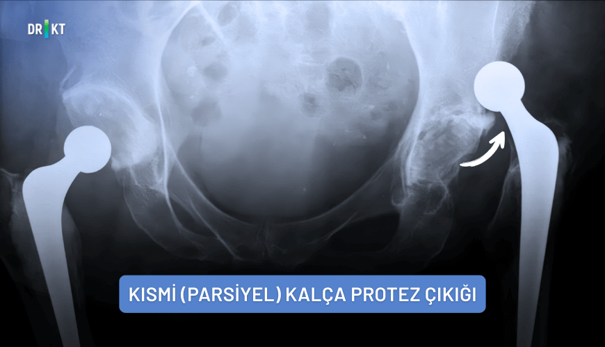 Kısmi (parsiyel) kalça protez çıkığı
