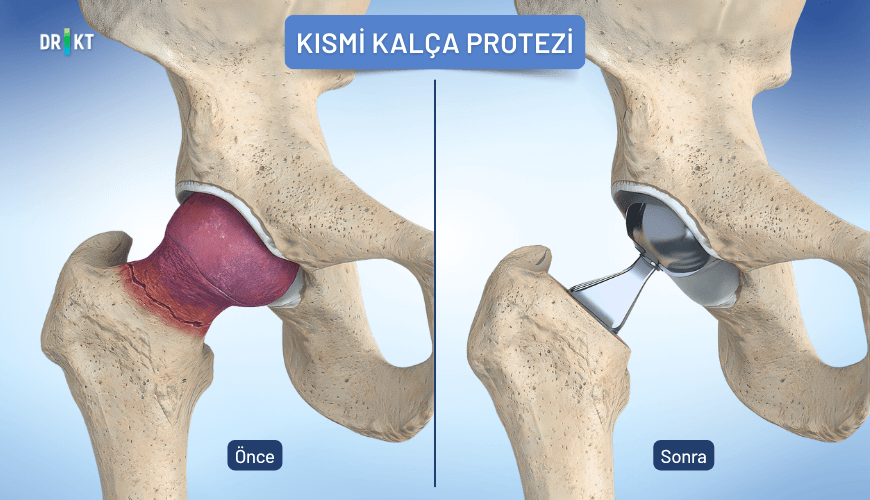 Kısmi Kalça Protezi