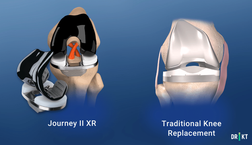 journey 2 xr vs traditional knee replacement