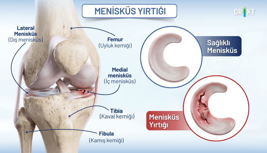 Menisküs yırtığı: diz eklemindeki menisküs dokusunun anatomisi