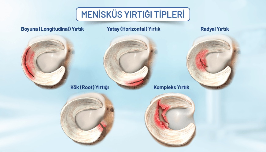Boyuna, yatay, radyal, kök ve kompleks menisküs yırtığı tiplerinin şematik gösterimi