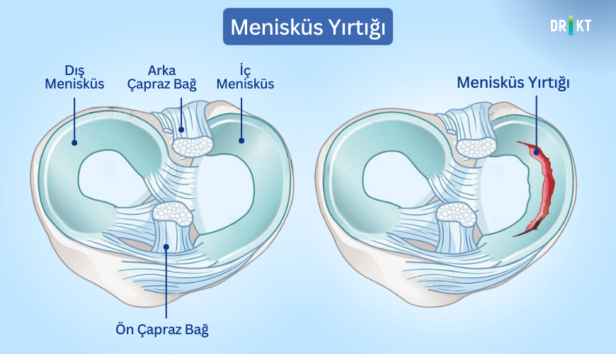 Menisküs yırtığı, çoğu zaman yaşanan travmalardan kaynaklı oluşur ve dizde ağrı ve şişliğe neden olabilir.