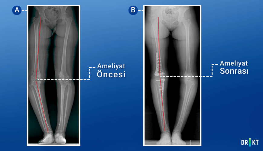  O bacak deformitesi olan bir hastada deformitenin yüksek tibial osteotomi ve distal femoral osteotomi ile düzeltilmesi. 