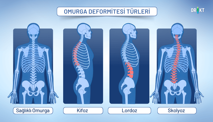 Skolyoz, kifoz ve lordoz gibi omurga deformiteleri, dengesiz yük dağılımı nedeniyle kalça ağrısına yol açabilir.
