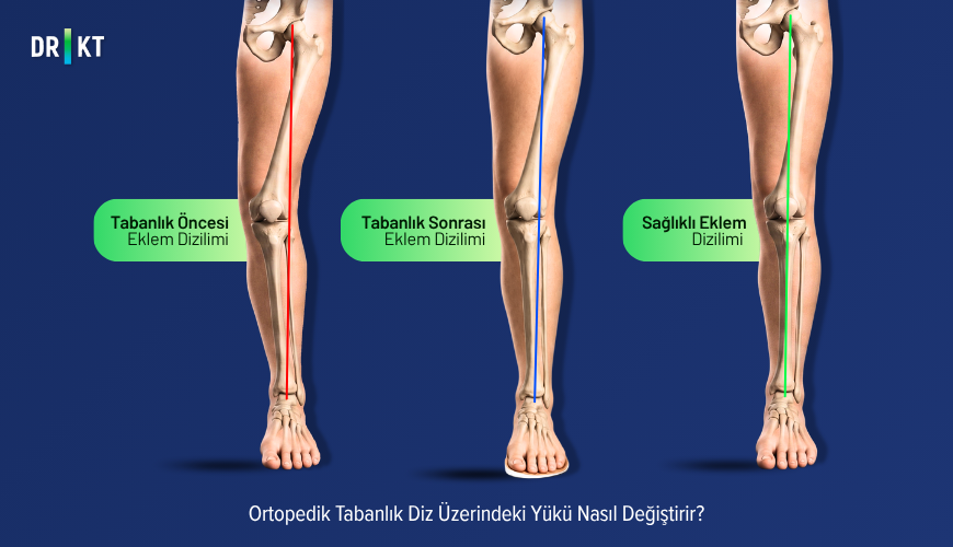 Ortopedik tabanlık diz üzerindeki yük dağılımını değiştirmeyi amaçlar