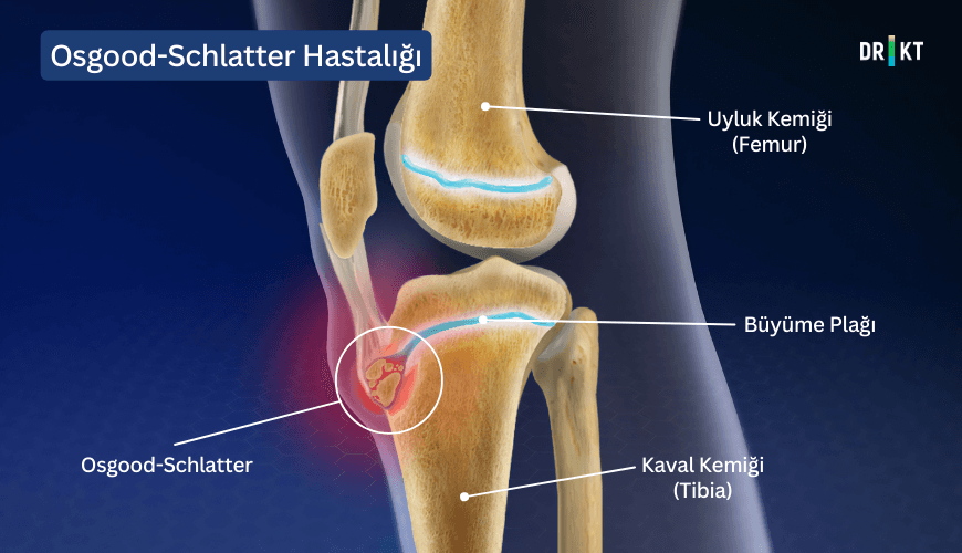 Osgood-Schlatter, genel olarak büyüme çağındaki çocuklarda ve gençlerde görülen, diz kapağının altında şişlik ve ağrıya neden olan bir rahatsızlıktır.