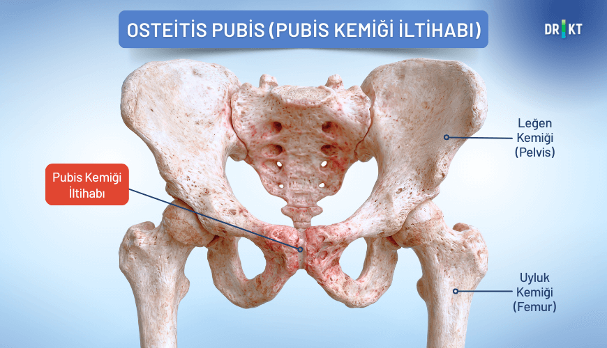 İki pubis kemiğinin birleştiği eklem yapısı (pubik simfiz) iltihaplandığında kasık ağrısına neden olabilir.