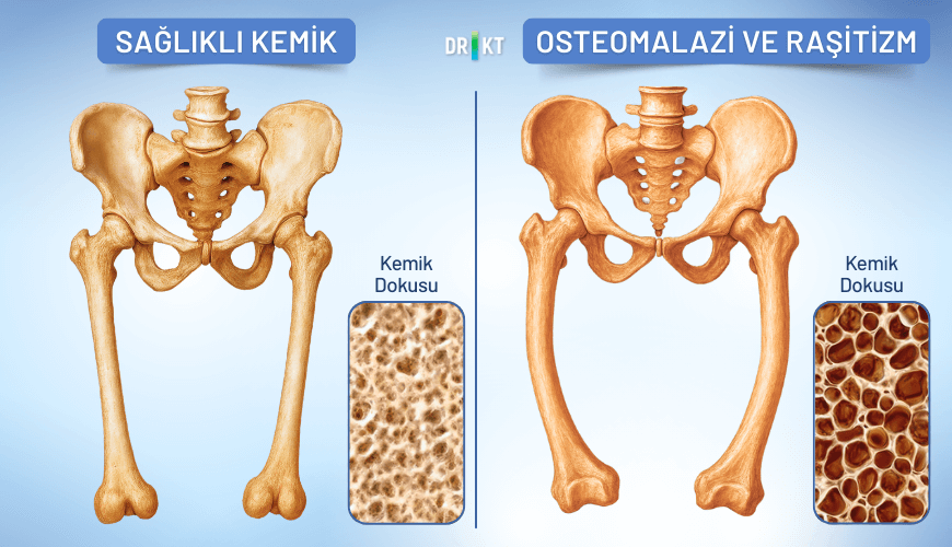Yetişkinlerde osteomalazi ve çocuklarda raşitizm olarak bilinen kemik yumuşaması, yaygın bir kemik ağrısı nedeni olup genellikle D vitamini eksikliğinden kaynaklanır.