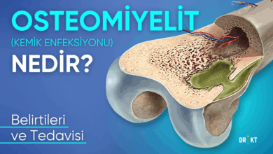 osteomileyit nedir
