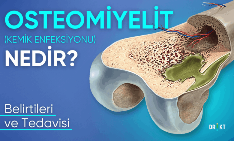 osteomileyit nedir