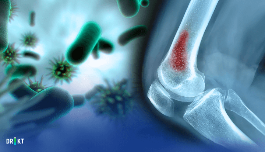  Osteomyelit, bakteri ve mantarların neden olduğu bir kemik enfeksiyonudur.