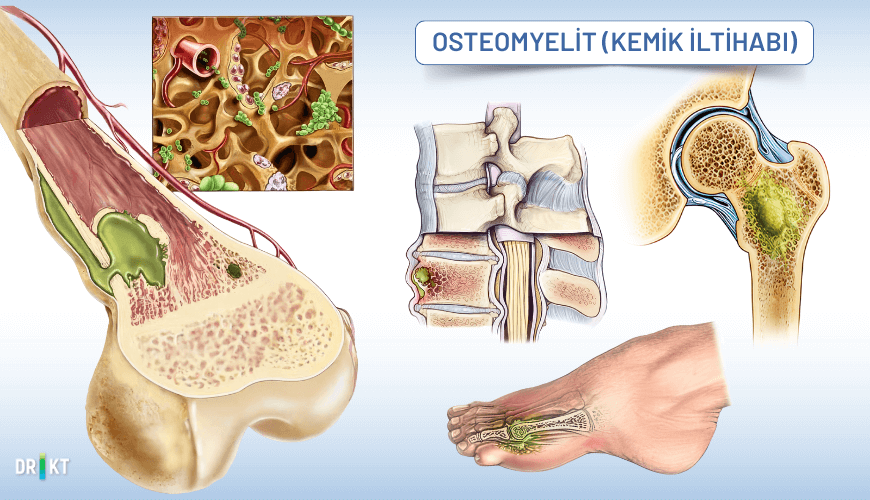 Kemik iltihabı olarak adlandırılan osteomyelit, enfeksiyonun etkilediği bölgede şişlik, ateş ve kemik ağrısı ile seyredebilir.