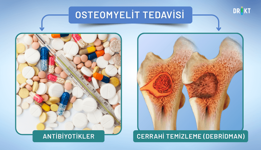 kemik enfeksiyonu tedavisi: Osteomyelit tedavisinde antibiyotik  ve cerrahi olarak bölgenin temizlenmesi yapılabilir. 