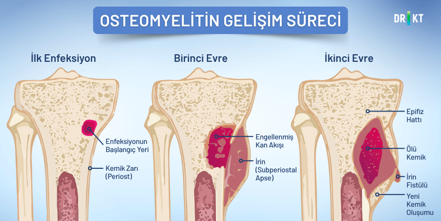 Osteomyelit Evreleri: başladığı bölgeden yayılarak kemikte çeşitli sorunlara yol açar.