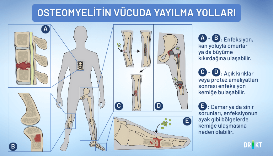 Osteomiyelit nasıl bulaşır? Mikroorganizmalar, kemiklere çeşitli yollardan ulaşarak kemik iltihabına sebep olabilir.