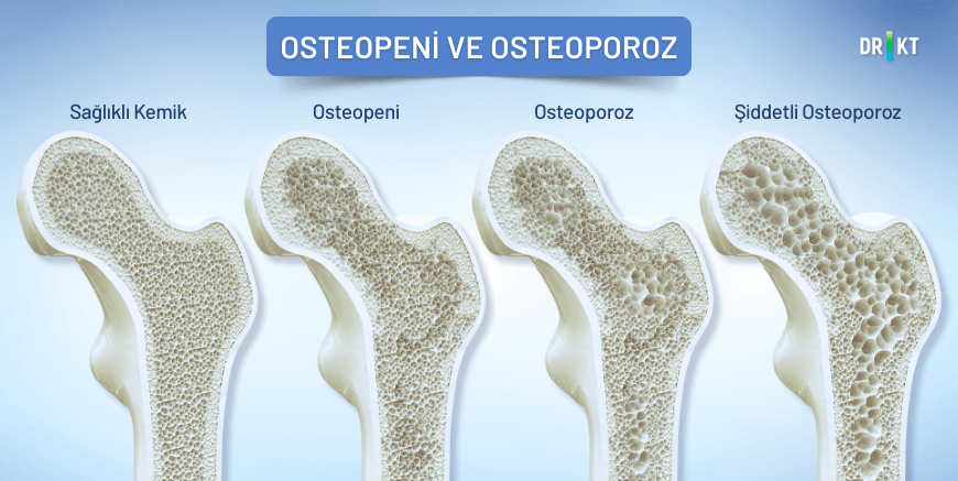 Osteopeni ile başlayan ve osteoporoz (kemik erimesi) ile devam eden kemik yoğunluğu kaybı, kırıklara ve omurgada meydana gelen çökme kırıklarına bağlı gelişebilen sırt kemik ağrısına zemin hazırlar.