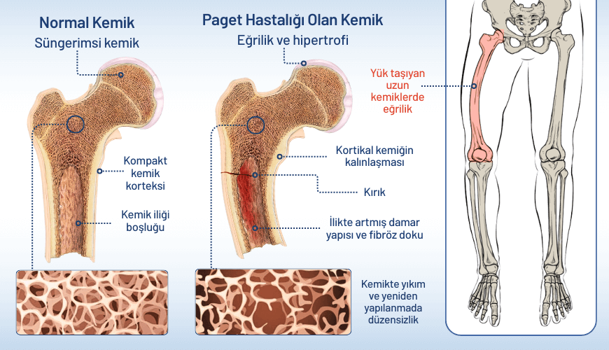 Kemik yenilenme sürecini bozan Paget hastalığı, özellikle leğen kemiği tutulumunda şiddetli bir kalça kemiği ağrısı ve yaygın kemik ağrısı ile kendini gösterebilir.