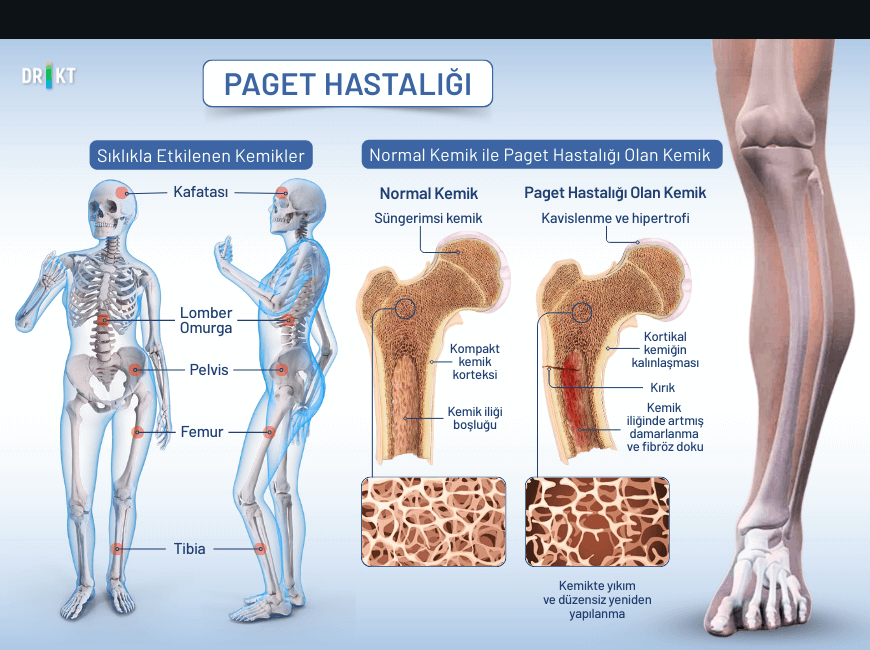  Kemiğin yeniden yapılanma döngüsünü bozan Paget hastalığı, kalça kemiğini etkilediğinde yürürken de hissedilen bir kalça ağrısı sorununa yol açar.