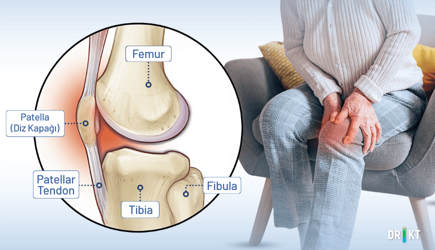  Dizin önünde, diz kapağının (patella) çevresinde veya arkasında hissedilen patellafemoral ağrı
