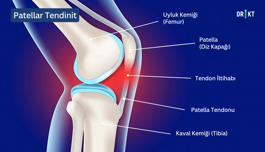 Diz kapağını kaval kemiğine bağlayan tendonda iltihaplanma olan patellar tendinit, diz kapağı altında şişlik ve ağrı yaratabilir.