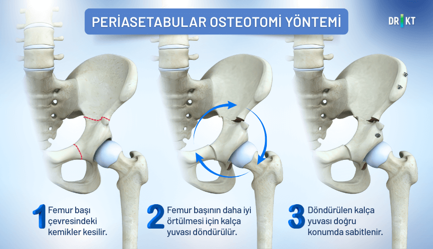 Yetişkinlerde kalça çıkığı ameliyatı “periasetabular osteotomi” yöntemi
