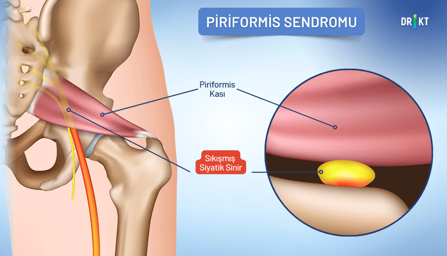 Siyatik sinirinin piriformis kası tarafından sıkıştırılması sebebiyle oluşan piriformis sendromu, bacağa da yayılabilen bir kalça içi ağrısı yaratabilir.