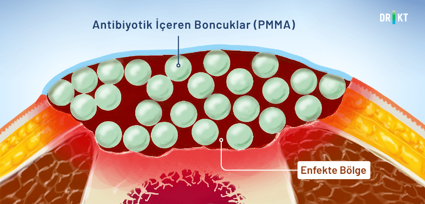 Osteomyelit ameliyatı sırasında enfeksiyonla başa çıkmak için enfekte bölgeye antibiyotik içeren boncuklar (PMMA) yerleştirilebilir.