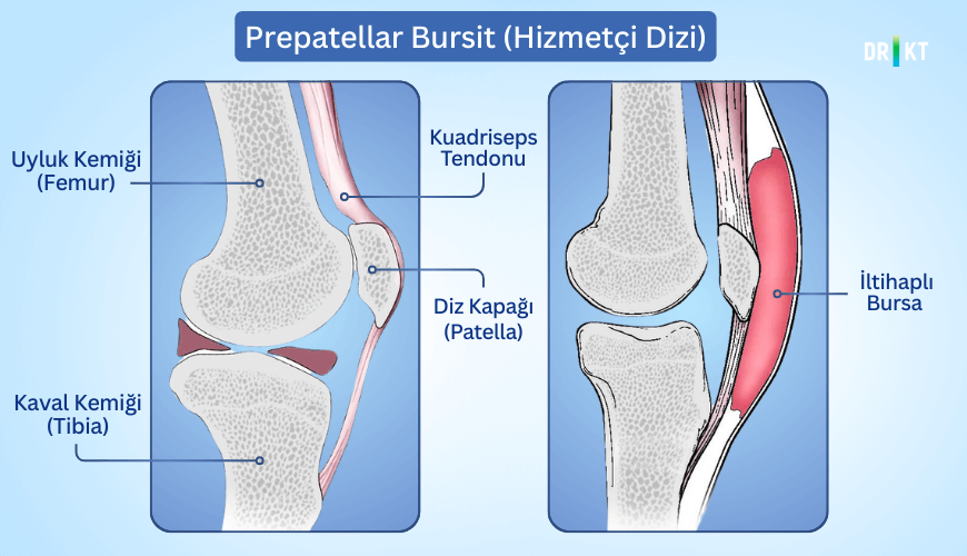 Prepatellar bursit, diz kapağının ön kısmındaki bursa adı verilen kesenin iltihaplanmasıdır ve bu nedenle diz kapağının üstünde şişlik ve ağrı meydana gelebilir.