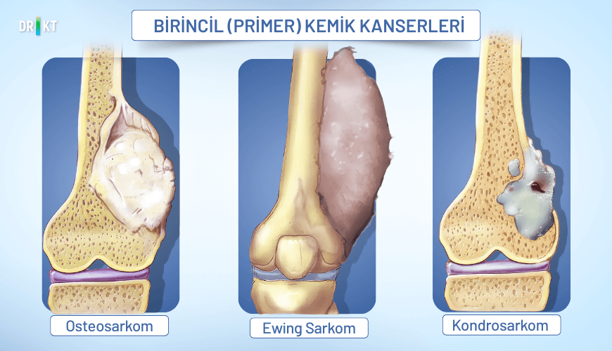  Doğrudan kemik hücrelerinde başlayan primer kemik kanserleri, çoğunlukla dinlenmekle geçmeyen ve zamanla kötüleşen bir kemik ağrısı yaratabilir.