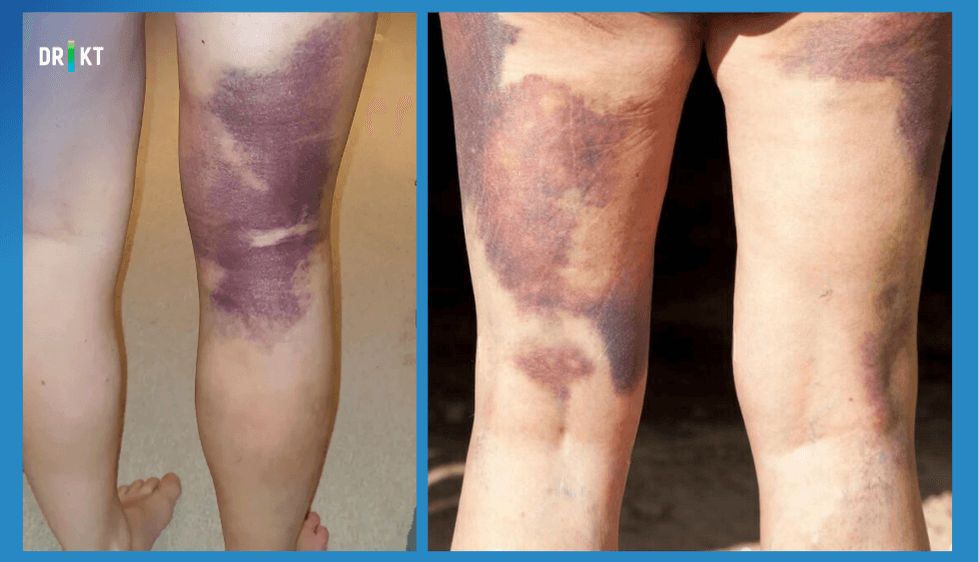bruising after prosthesis surgery