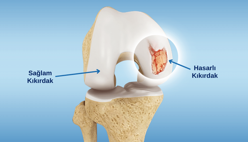 Dizin osteokondral bölgesindeki kıkırdak dokunun bozulması (sağ kırmızı ok ile belirtilen bölge) zamanla kemikte de yapısal bozulmalara neden olabilir.