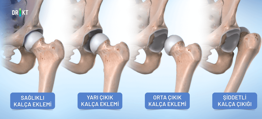 sağlıklı kalça eklemi ve çıkıklar
