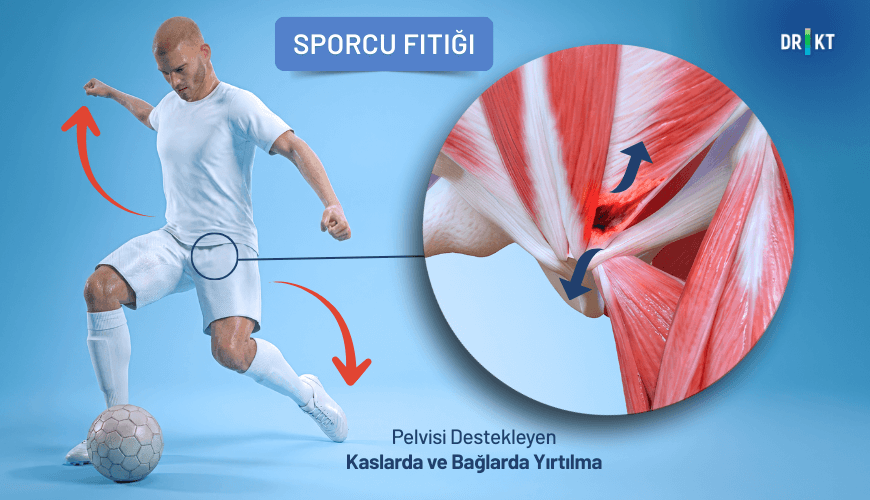 Dinlenince hafifleyen ancak aktivite sırasında tekrar başlayan kasık ağrısı, sporcu fıtığı olarak bilinen doku hasarının işaretlerinden biridir.