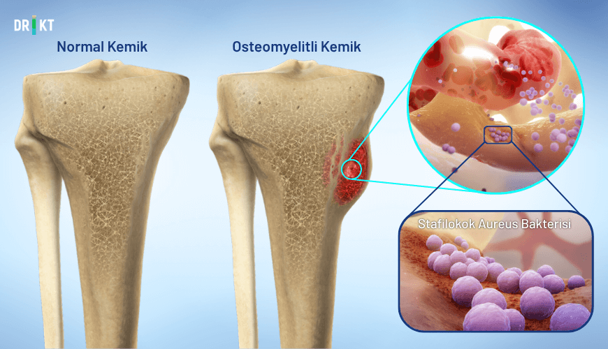 Osteomyelite en sık neden olan etken, Stafilokok aureus bakterisi olarak karşımıza çıkar. 