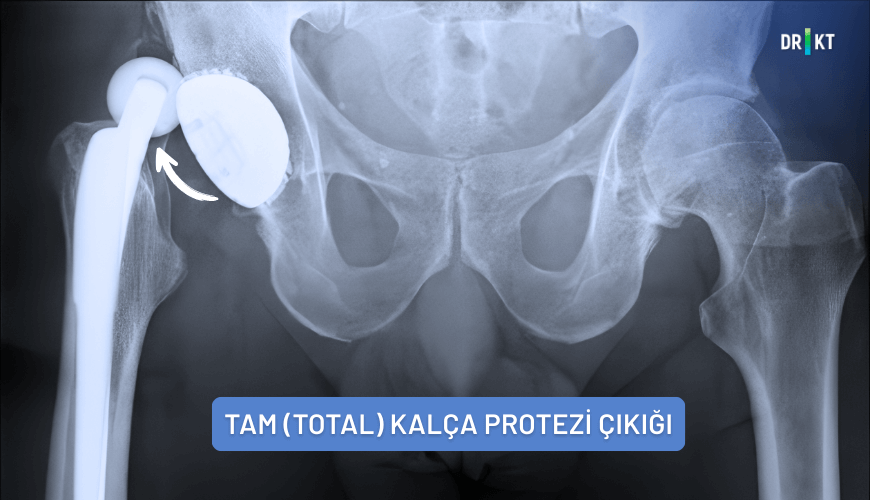 Tam (total) kalça protezi çıkığı
