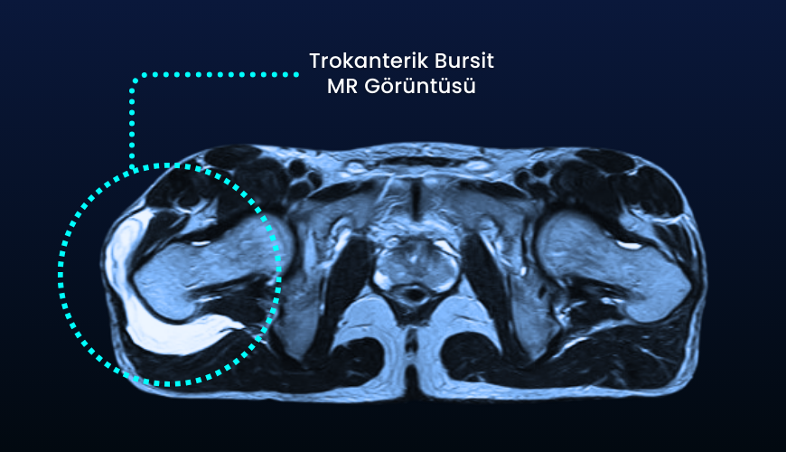 trokanterik bursit mr görüntüsü