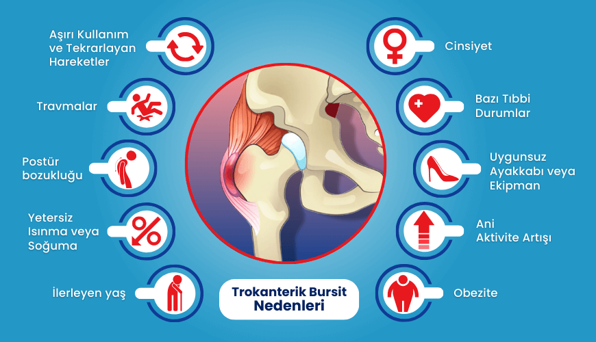 trokanterik bursit neden olur