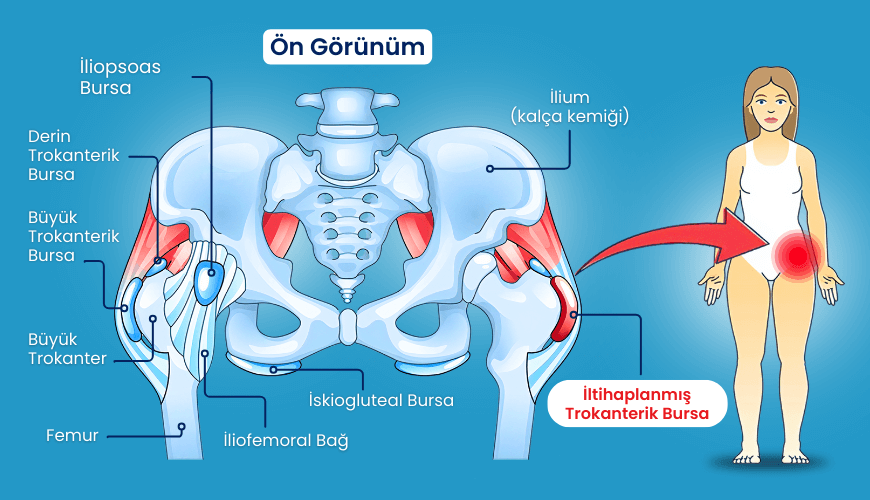 trokanterik bursit
