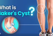 what is bakers cyst