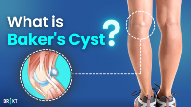 what is bakers cyst