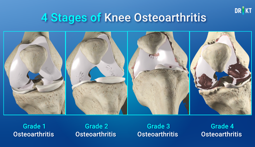 What is knee surgery