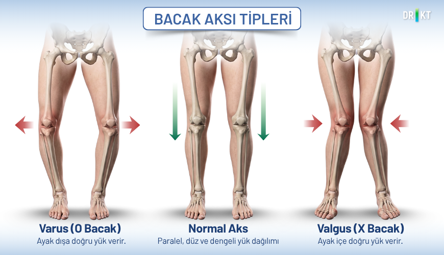 Günlük yaşamda X ve O bacak olarak bilinen valgus ve varus deformitesi de yürüyüşümüzü etkilemektedir.
